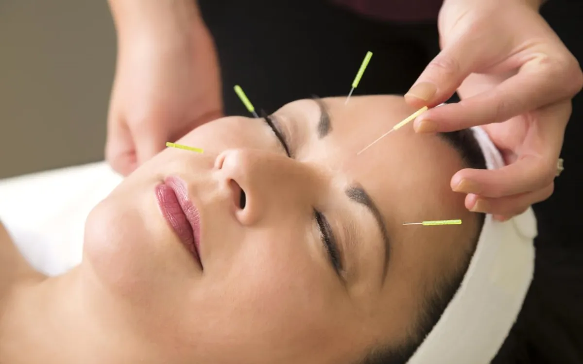 Akupunktur ile Ağrı Tedavisi